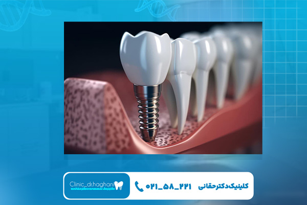 شرایط لازم کاشت ایمپلنت دندان