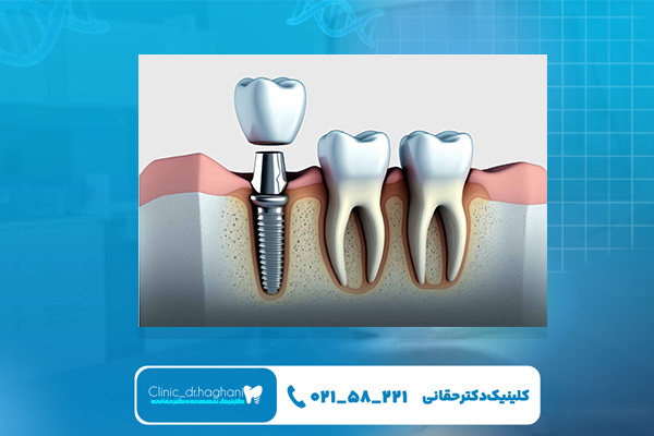 کاشت ایمپلنت در کلینیک تمام دیجیتال