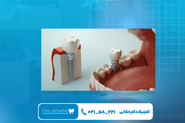 مراحل کامل کاشت ایمپلنت دندان دیجیتال