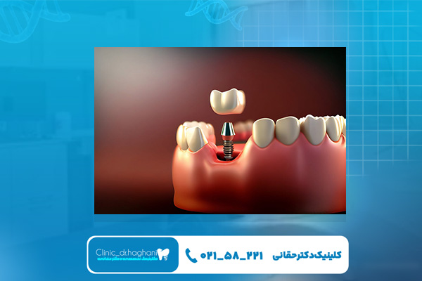 تجربه زیبایی با ایمپلنت‌ دیجیتال دندان