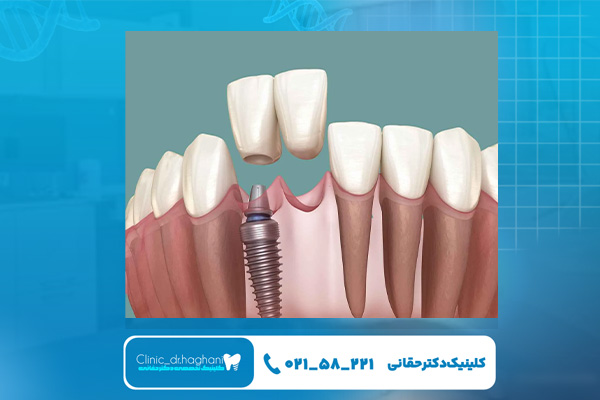 قیمت ایمپلنت‌ دندان و عوامل مؤثر 