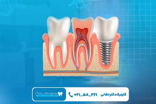 مراحل انجام ایمپلنت‌ دندان