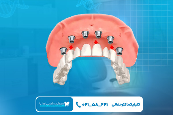 کلینیک ایمپلنت کلینیک ایمپلنت