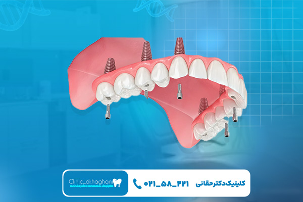 کلینیک ایمپلنت در تهران کلینیک ایمپلنت در تهران