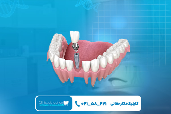 کلینیک ایمپلنت کلینیک ایمپلنت