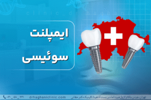 ایمپلنت سوئیسی