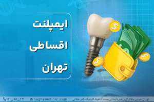 ایمپلنت اقساطی تهران