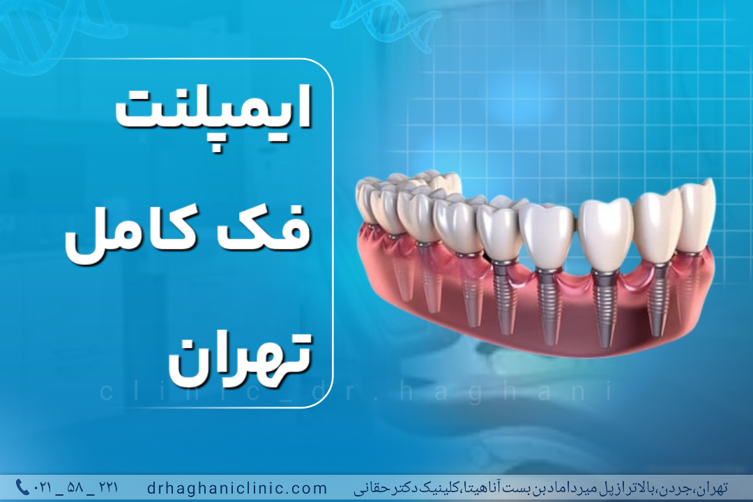 ایمپلنت فک کامل تهران