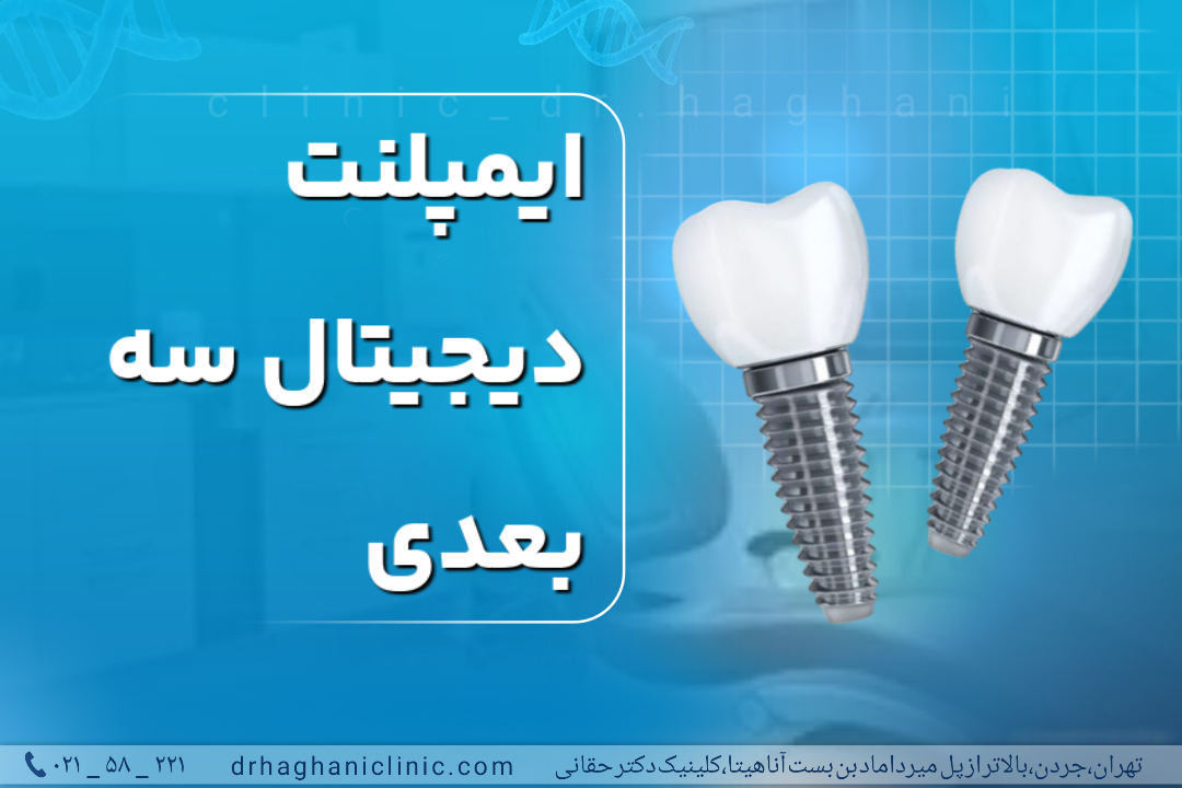 ایمپلنت دیجیتال سه بعدی