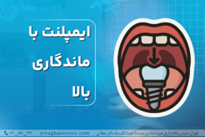ایمپلنت با ماندگاری بالا