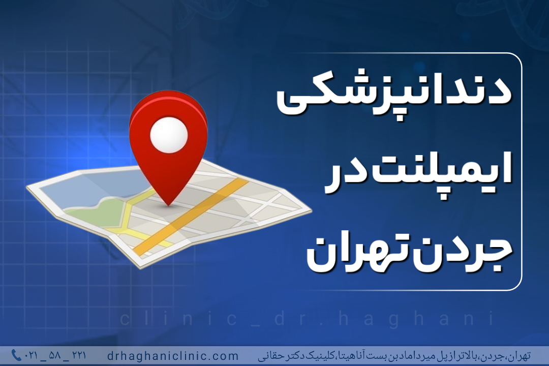 دندانپزشکی ایمپلنت در جردن تهران