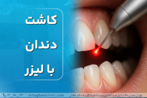 کاشت دندان با لیزر