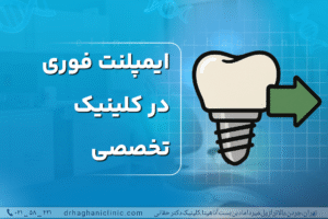 ایمپلنت فوری در کلینیک تخصصی