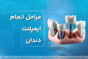 مراحل انجام ایمپلنت دندان