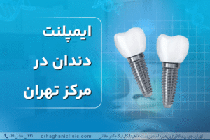 ایمپلنت دندان در مرکز تهران