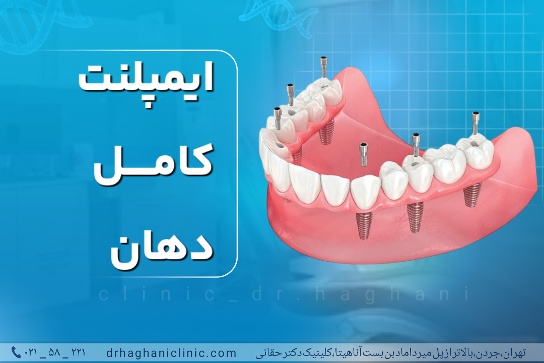 ایمپلنت کامل دهان