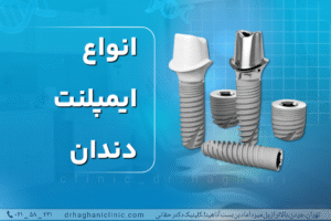 انواع ایمپلنت دندان