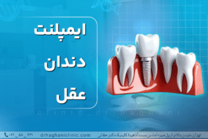 ایمپلنت دندان عقل