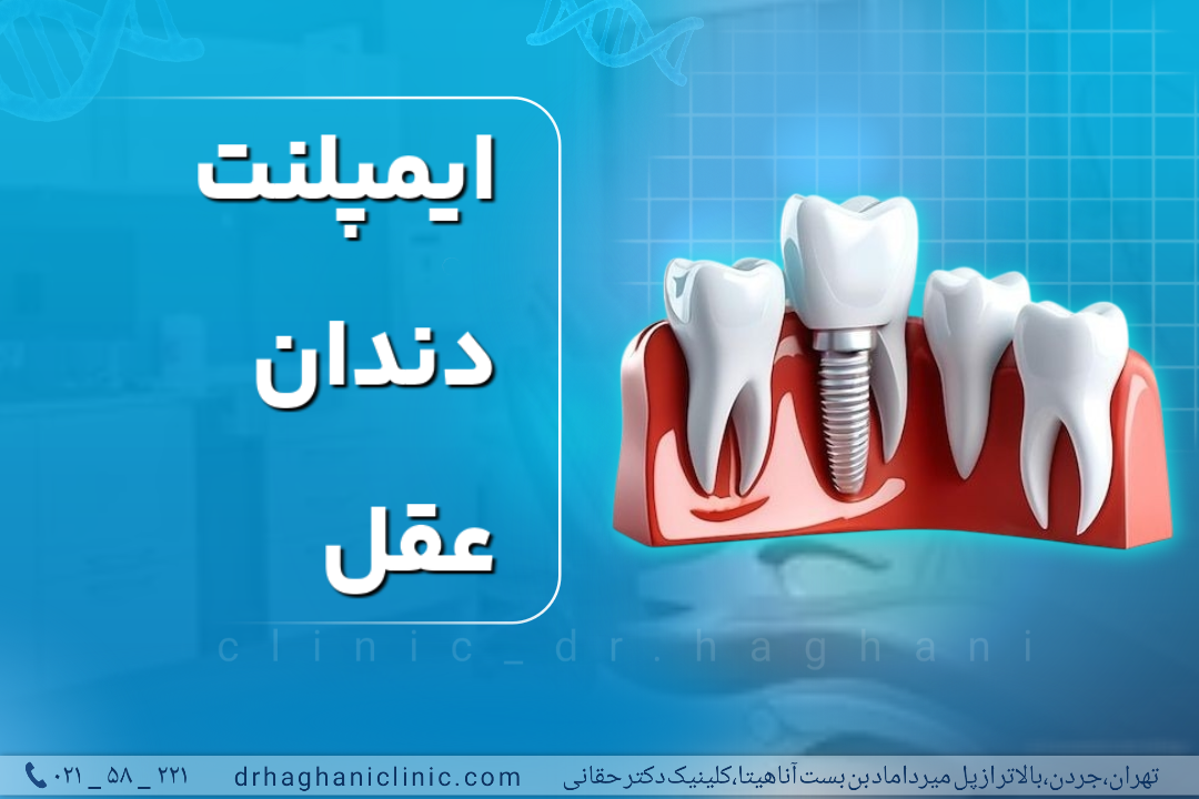 ایمپلنت دندان عقل