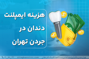 هزینه ایمپلنت دندان در جردن