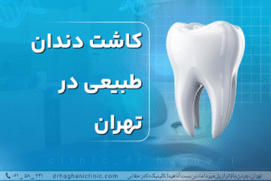 کاشت دندان طبیعی در تهران