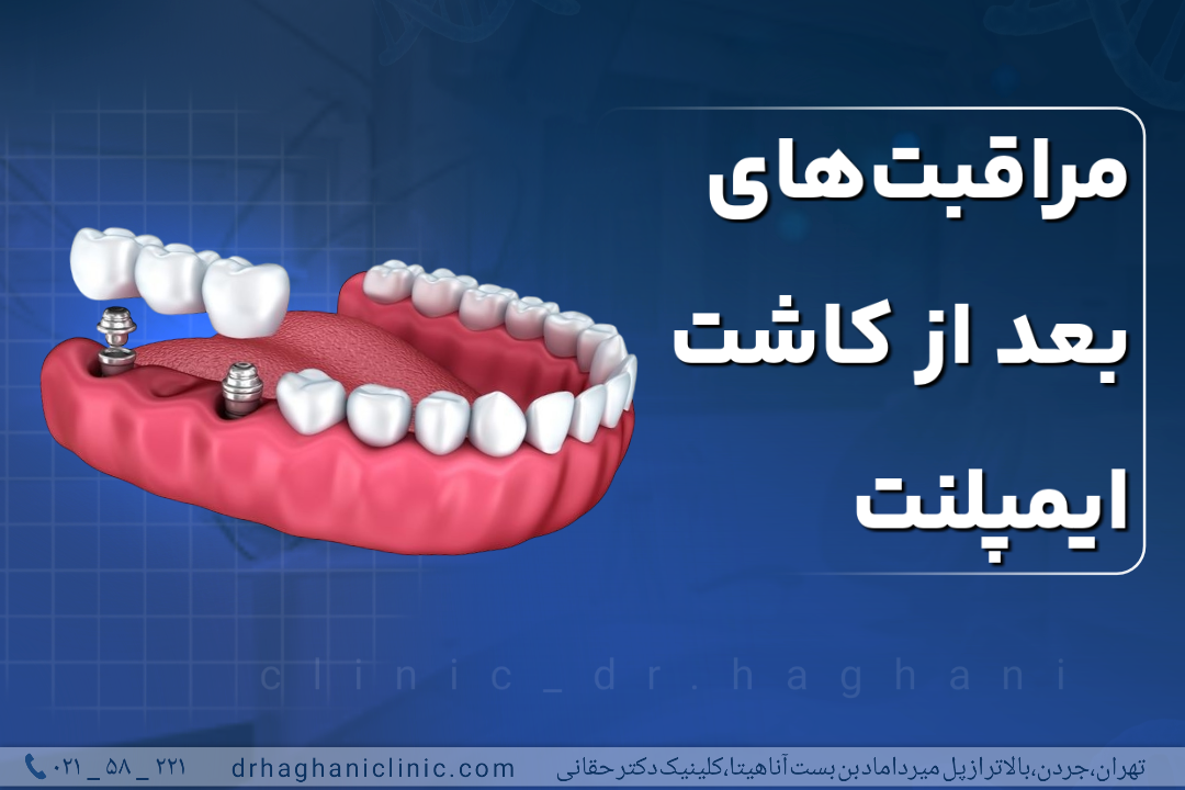 مراقبت های بعد از کاشت ایمپلنت