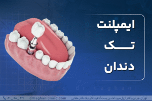 ایمپلنت تک دندان