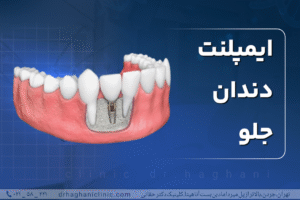 ایمپلنت دندان جلو