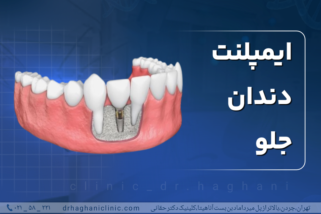 ایمپلنت دندان جلو
