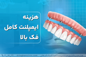 هزینه ایمپلنت کامل فک بالا