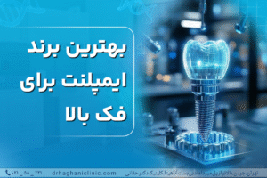 بهترین برند ایمپلنت برای فک بالا