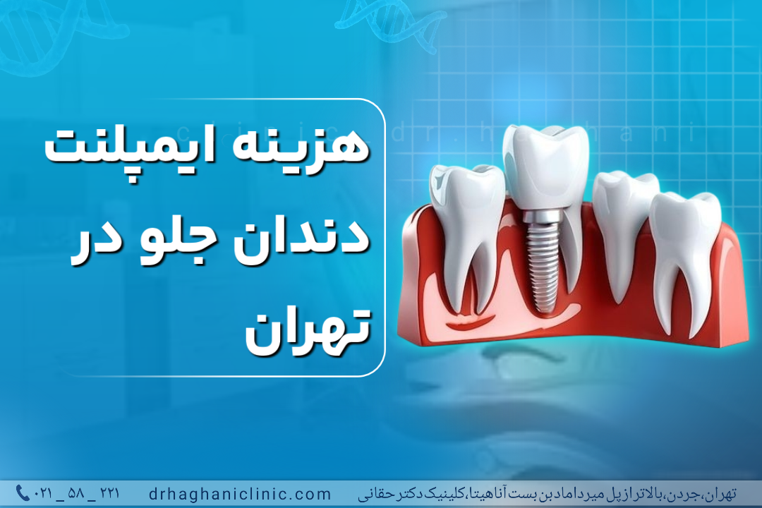 هزینه ایمپلنت دندان جلو در تهران