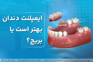 ایمپلنت دندان بهتر است یا بریج