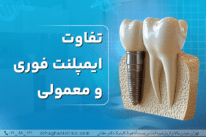 تفاوت ایمپلنت فوری و معمولی