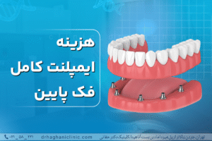 هزینه ایمپلنت کامل فک پایین