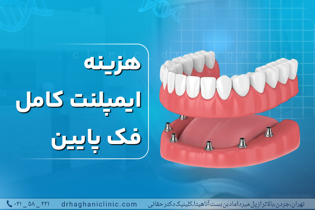 هزینه ایمپلنت کامل فک پایین