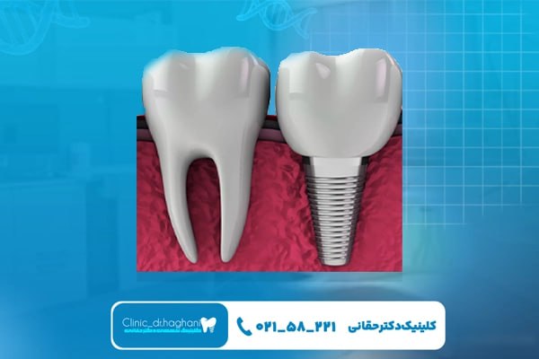چرا جایگزینی دندان عقل با ایمپلنت بهتر است؟