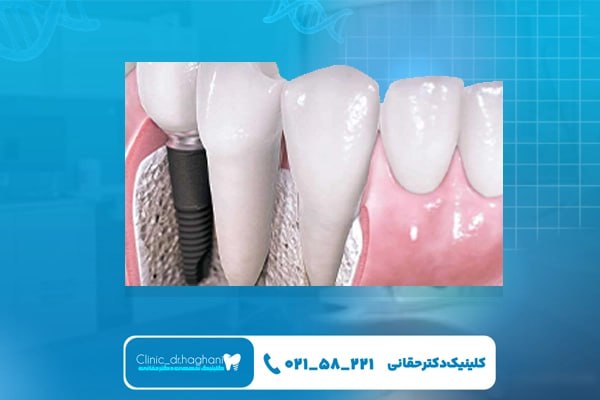 ضرورت ایمپلنت‌ دندان عقل