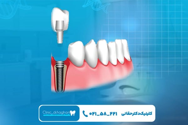 ایمپلنت دندان عقل