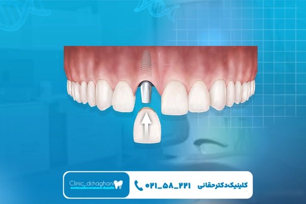 مراحل مختلف انجام ایمپلنت دندان جلو مراحل مختلف انجام ایمپلنت دندان جلو