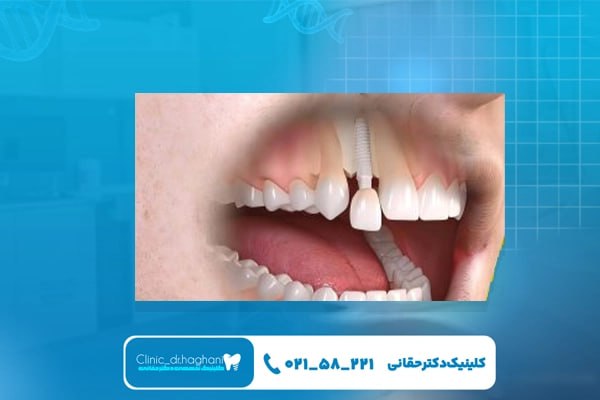 قیمت ایمپلنت دندان جلو در سال قیمت ایمپلنت دندان جلو در سال