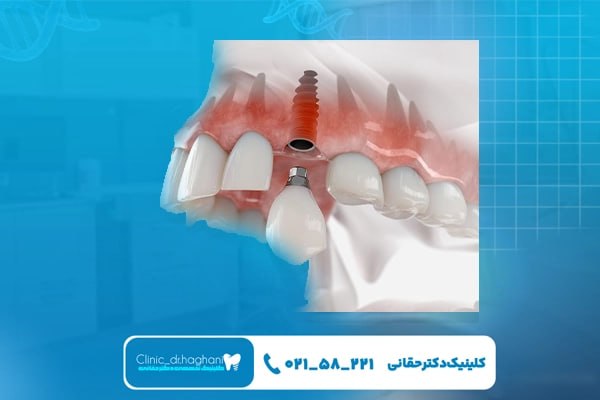 ایمپلنت دندان جلو ایمپلنت دندان جلو