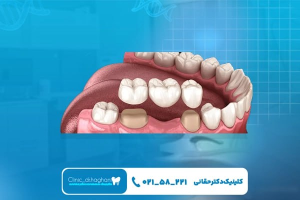 قیمت کاشت دندان طبیعی در تهران