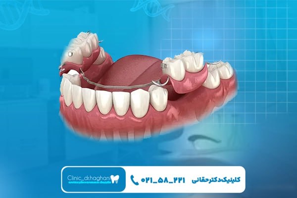 کاشت دندان طبیعی در تهران