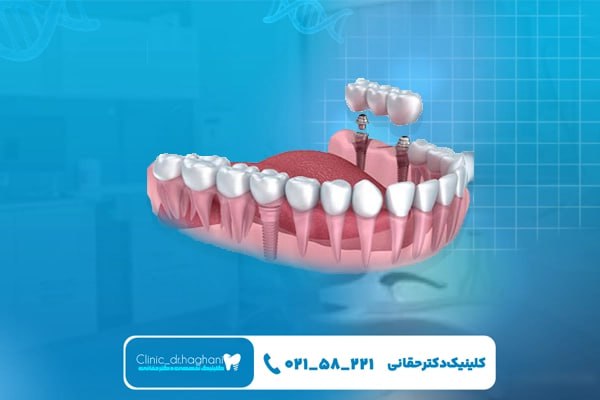 مزیت‌های کاشت دندان طبیعی 