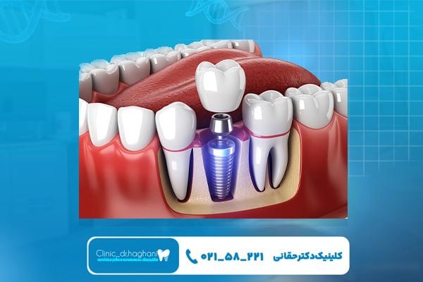 مزیت‌های کاشت ایمپلنت