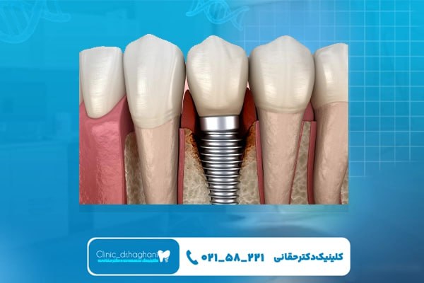 تفاوت بین ایمپلنت دندان و پروتز دندان