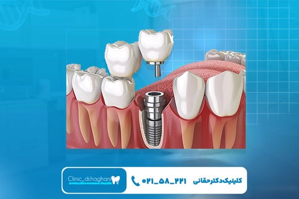بهترین دندانپزشک کاشت و پروتز دندان