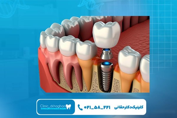 برندهای ایمپلنت کره‌ای
