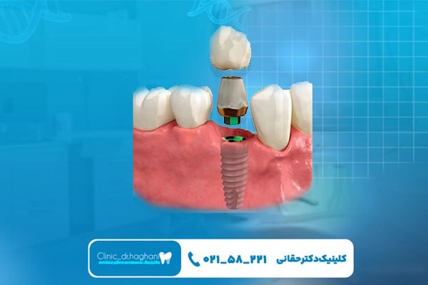 برندهای ایرانی ایمپلنت دندان